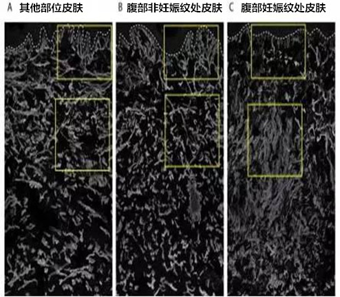 搪塞怀胎纹 为啥油或霜结果不明显？